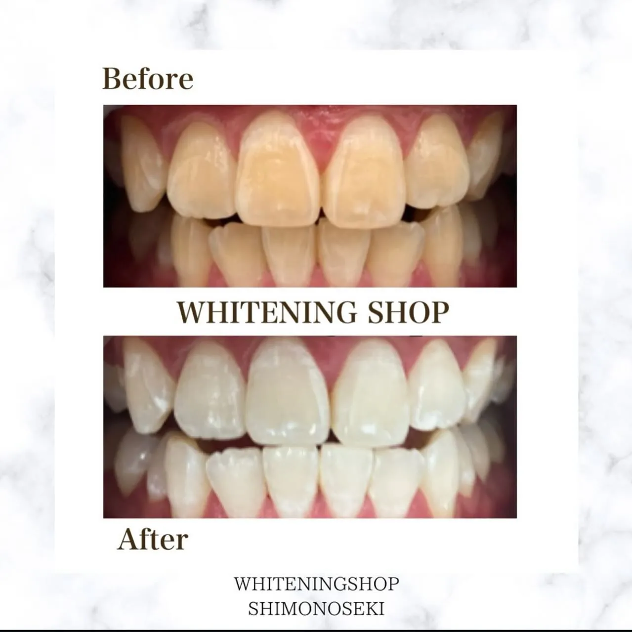 お客様のbefore after 🦷✨️