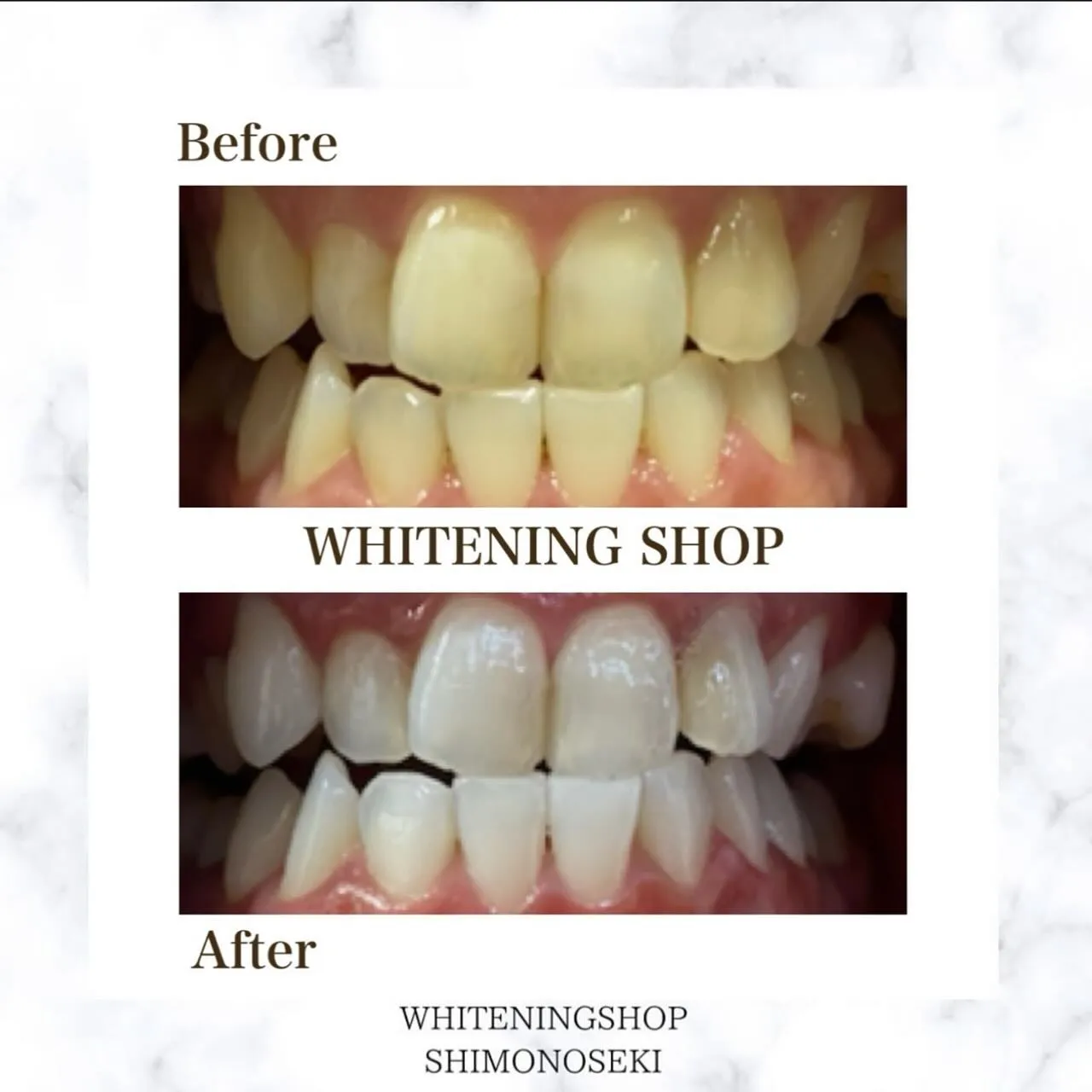 お客様のbefore after🦷✨️