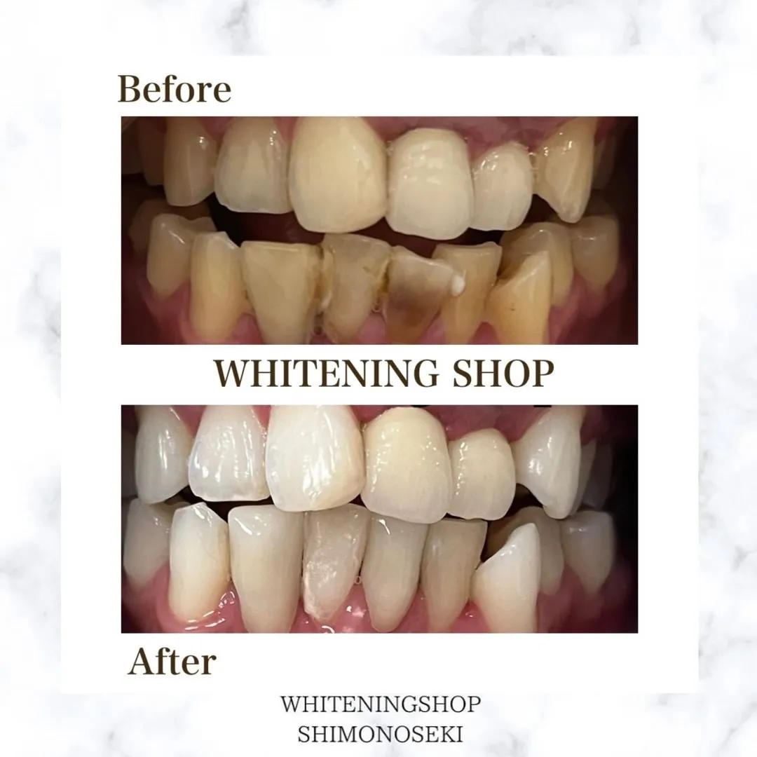 お客様のBefore After🦷✨️