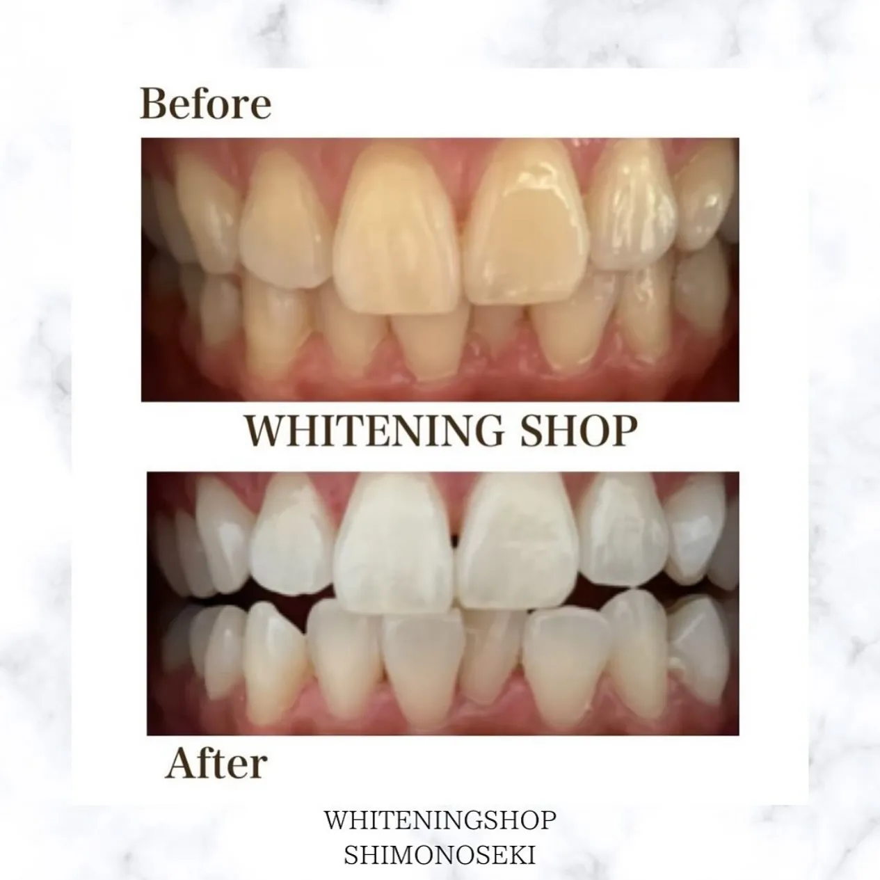 お客様のbefore after🦷✨️