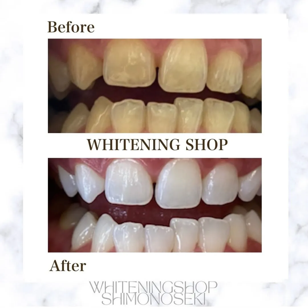 お客様のbefore after🦷✨️