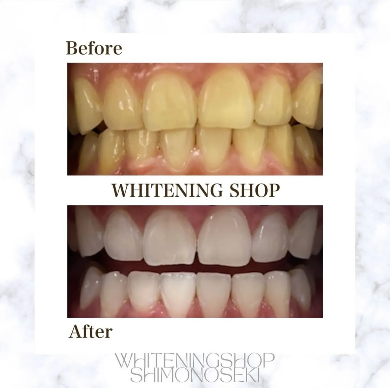 お客様のBefore After🦷✨