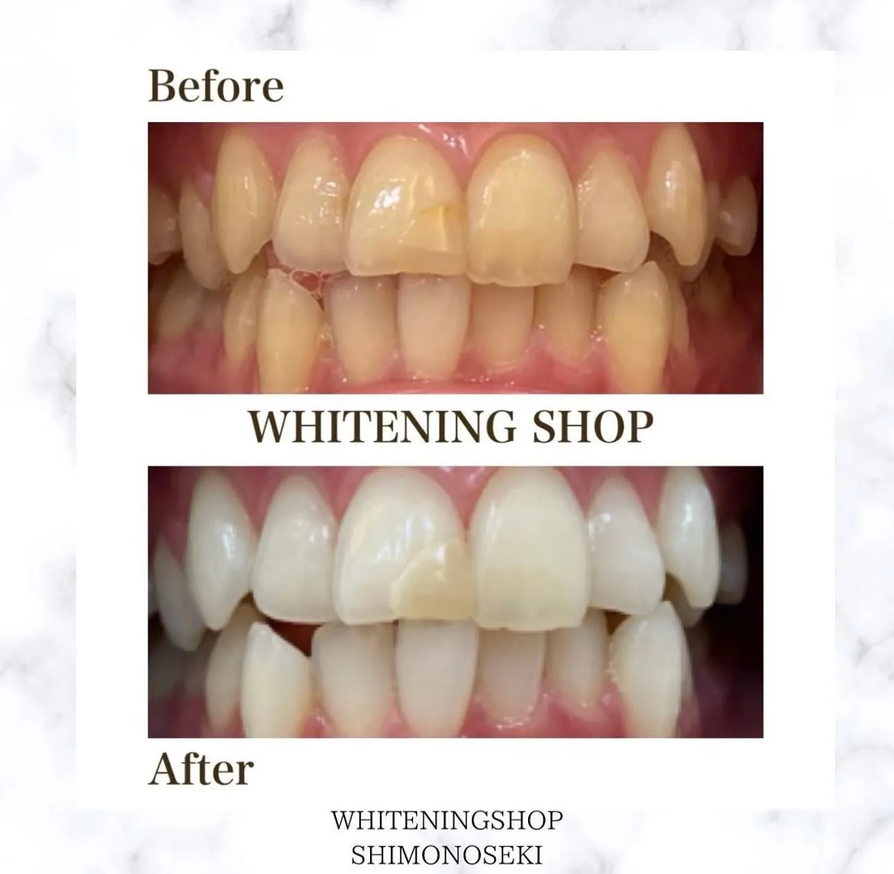 お客様のbefore after🦷✨️