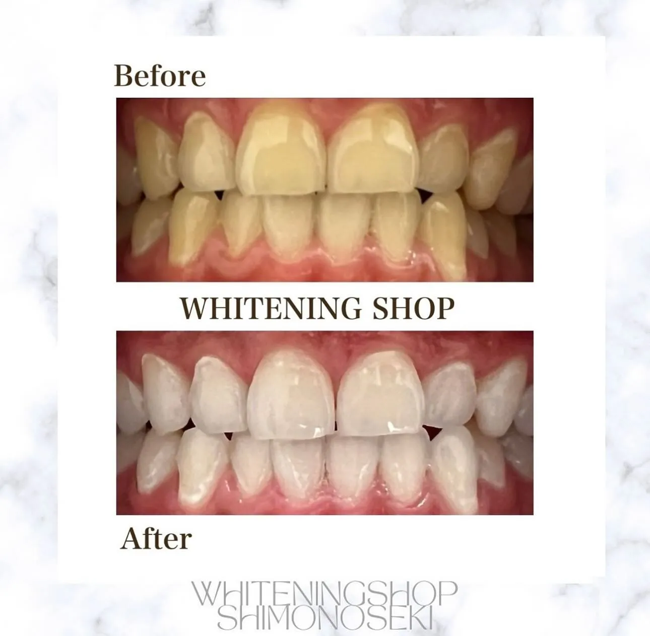 お客様のBefore After🦷✨️