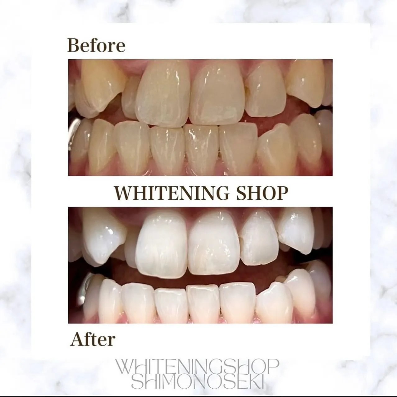 こんにちはホワイトニングショップ下関店です🦷✨️